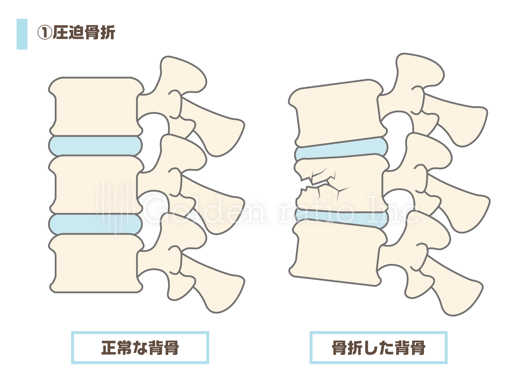 圧迫骨折とは何ですか？